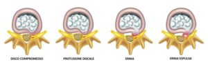 ernia del disco lombare