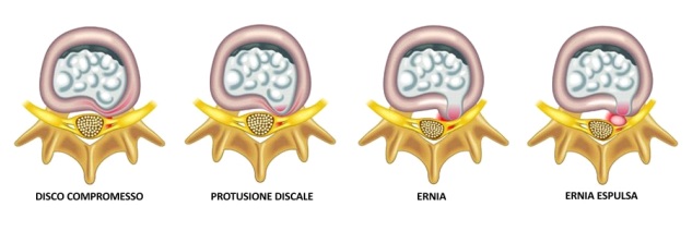 ernia del disco lombare