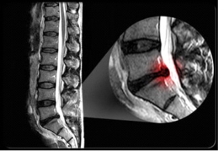 ernia del disco lombare