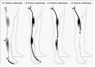 ernia del disco lombare