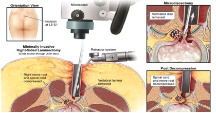 ernia del disco lombare