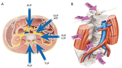 SPONDILOLISTESI LOMBARE-2