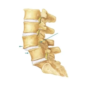 Spondilolistesi lombare